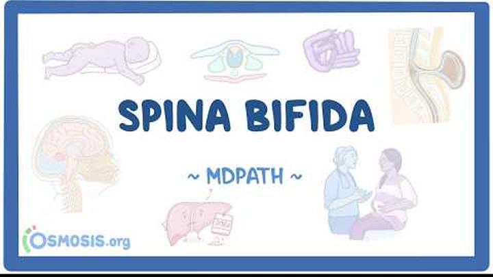 Spina bifida - physiology, pathology, clinical manifestations, diagnosis, treatment